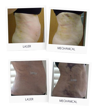 BeautiFill VS Liposuzione meccanica BeautiFill VS Liposuzione meccanica